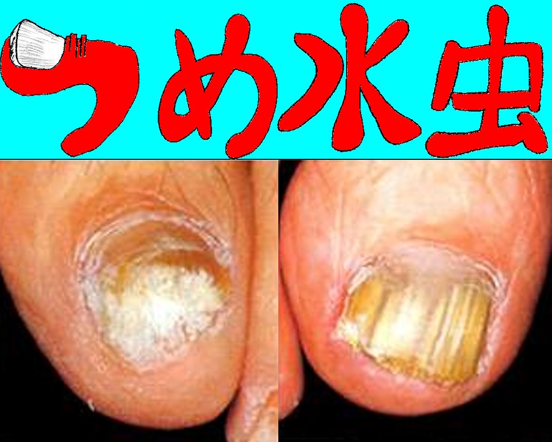 バナー_つめ水虫